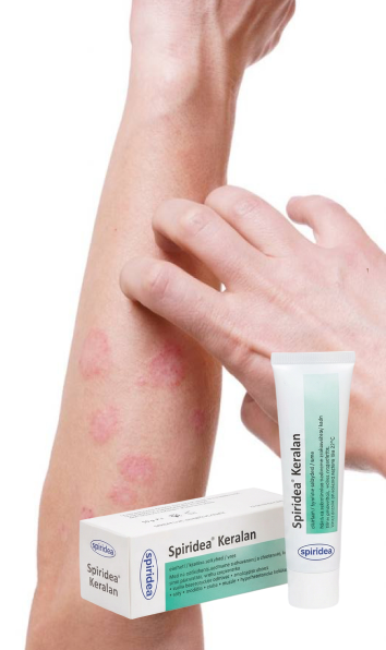 Atopic dermatitis