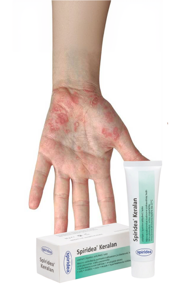 Psoriasis